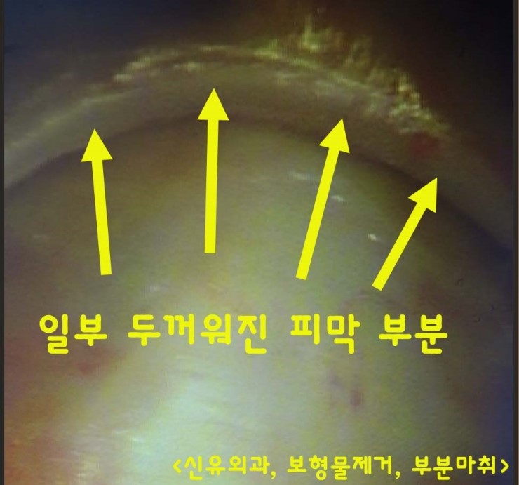 동그랗게 두꺼워진 피막의 일부만 제거하고, 가슴보형물제거수술했던 분