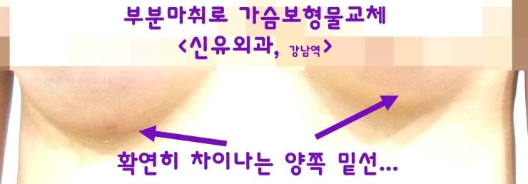밑선절개없이 밑선 내리는 교정수술을 부분마취로 하며 가슴보형물교체 스무스로 했던 분