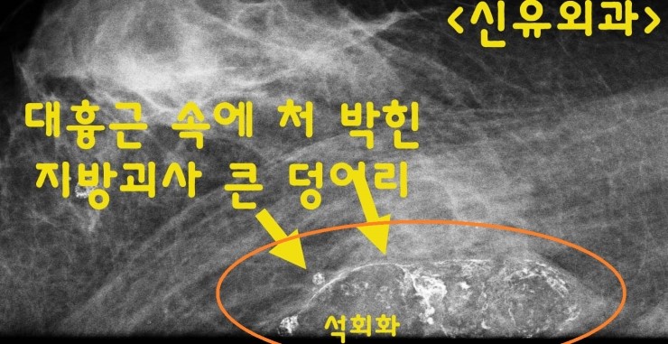 가슴지방이식석회화 부작용으로 괴사되어 녹아버린 지방조직과 며칠에 걸쳐 고름(농양)을 제거