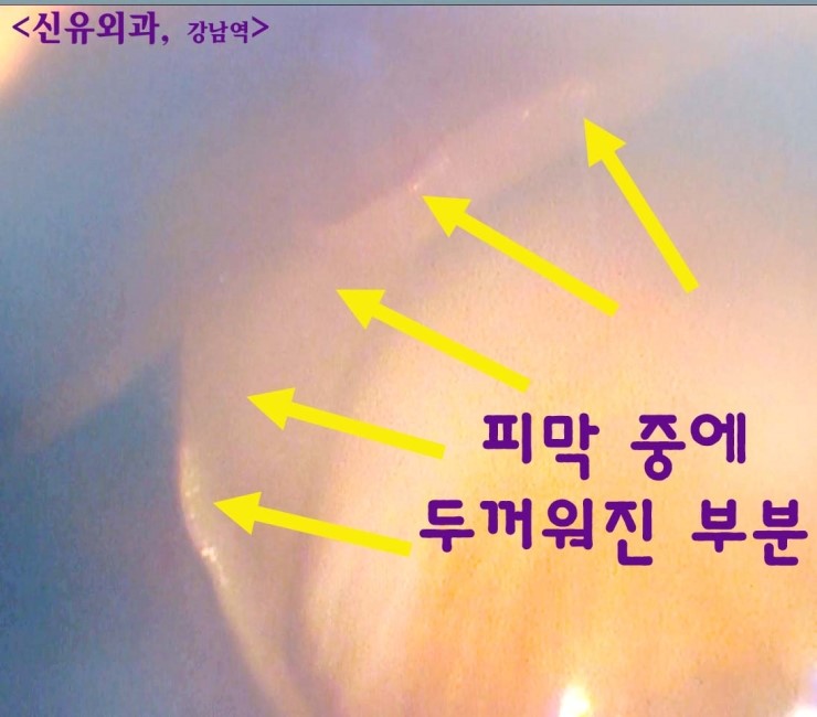 가슴보형물과 두꺼운 피막 일부 제거를 모두 부분마취로 하고, 맘모톰수술까지 동시에 했던 경우