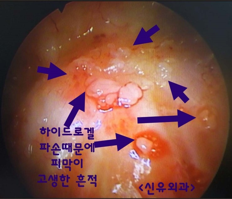 18년전 넣었던 하이드로겔 파손으로 피막이 고생한 흔적이 보이던 분