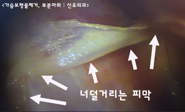 가슴보형물파손후 8년만에 제거하신 경우