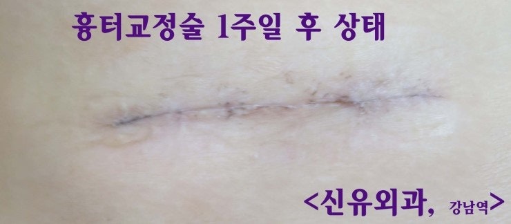 가슴보형물제거 부분마취로 아프지 않아 좋았던 것보다, 흉터교정술에 더 만족하셨던 분
