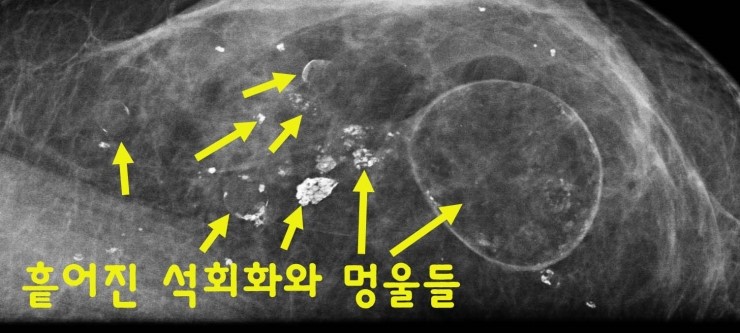 실제 지방이식으로 가슴이 3배로 커졌으나, 부작용석회화 또한 크게 존재했던 분