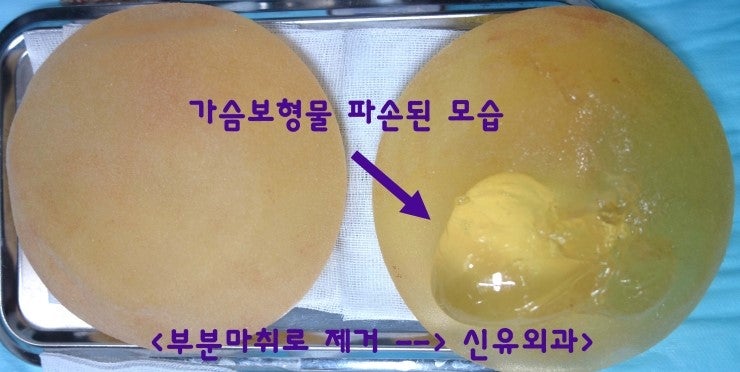 가슴보형물파손이 가장자리가 아니라 가운데 중심부분에 일어났던 분 제거수술후기