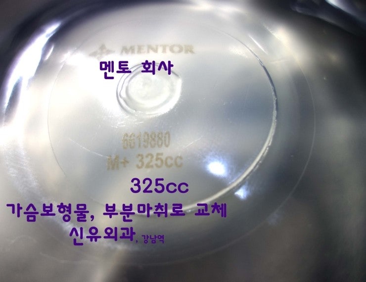 325cc를 200cc로 부분마취하여 교체한 경우(가슴보형물이 너무 커서 부담스러워서)