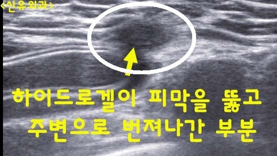 하이드로겔 가슴보형물 --> 피막외파손으로 조직이 녹아버렸던 분