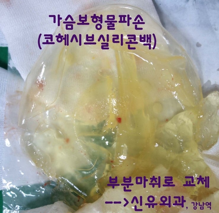 여의사선생님 가슴보형물파손제거/교체하면서 밑선찝어서 하방변위도 같이 부분마취로 교정한 분.