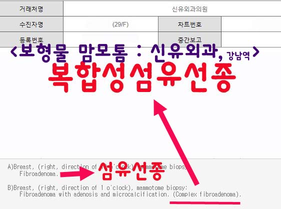 가슴보형물은 뒤집어졌고, 복합성섬유선종은 2mm 떨어져 있는데 안전하게 가슴성형후맘모톰으로 제거