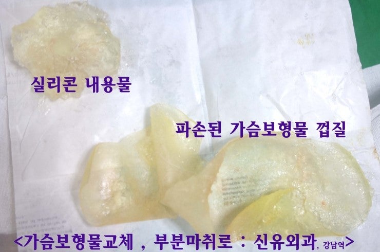 물방울가슴보형물 290cc 파손되어 방 더 넓히고 300cc 스무스로 부분마취로 교체