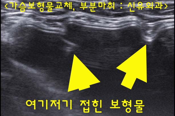 가슴이 네 개가 된 경우--> 임신출산수유후 처져서 vs 나이가 들어서 