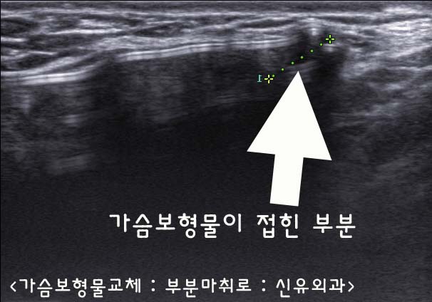 가슴이 아파서 구형구축인 줄 알았는데 보형물이 접혀서 찌르는 경우 --> 피막 일부가 두꺼워짐 