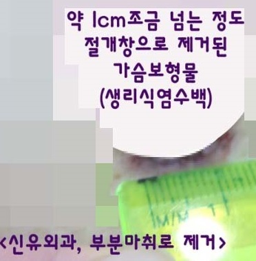 1.3cm 작은 절개로 부분마취하여 생리식염수백 간단히 제거+ 맘모톰도 동시에.