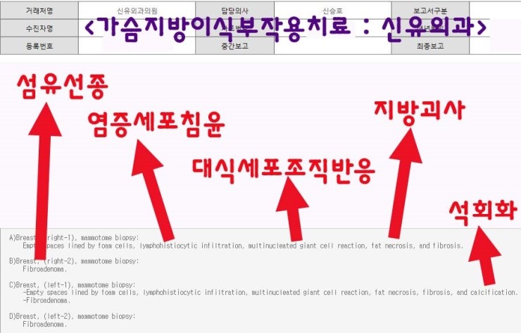 줄기세포prp가슴지방이식성형수술로 4mm 두꺼워지기는 했으나 지방괴사석회화부작용도 같이 나왔던 분. 