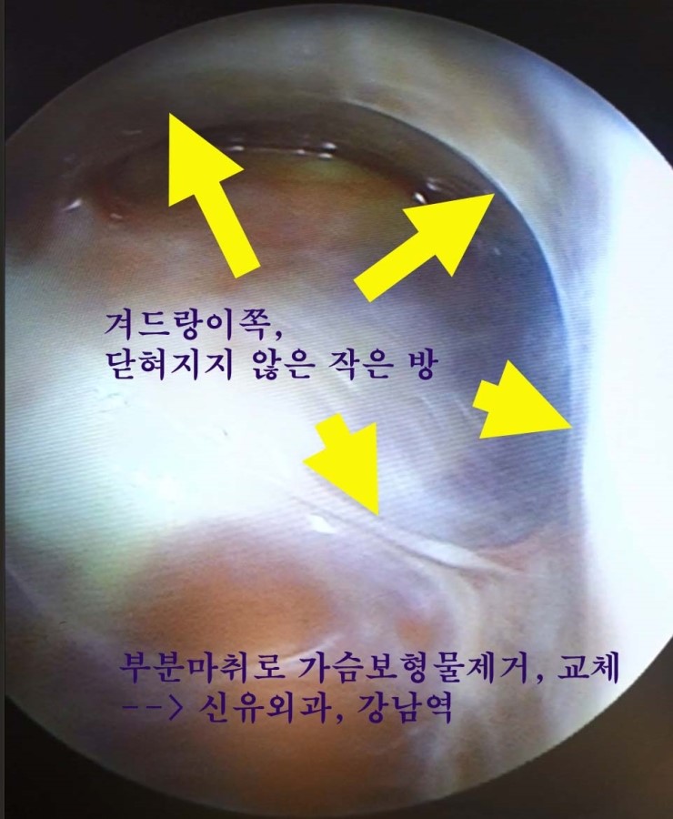 오래된 생리식염수백을 쏙 빼낸 후 스무스 코젤 같은 사이즈로 가슴보형물제거/교체를 했던 분