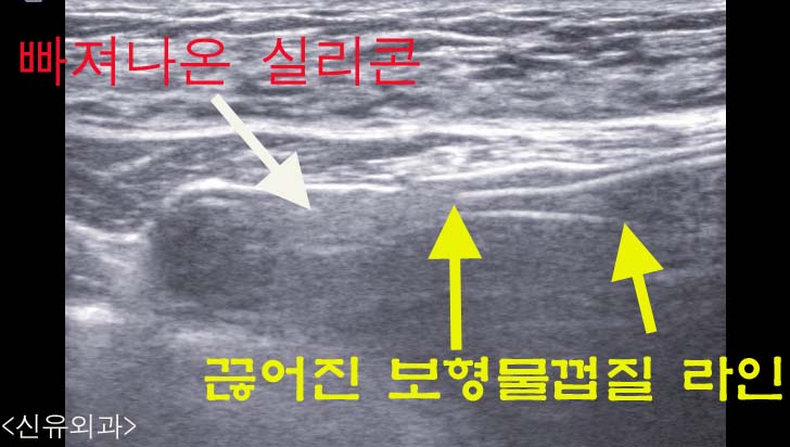 유방검진상 우연히 발견된 가슴보형물파손 & 물방울 비유착으로 인한 회전. 