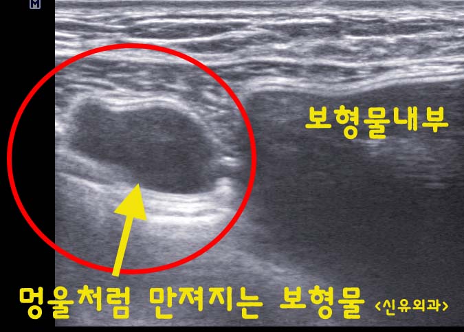 가슴에 만져지는 멍울의 정체는... 보형물이 삐져 나오고 눌린 것. 파손되지 않았는데도. 