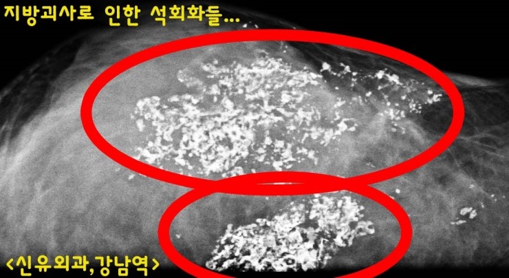 유방암으로 오인되기 쉬운 가슴자가지방이식부작용석회화병변들