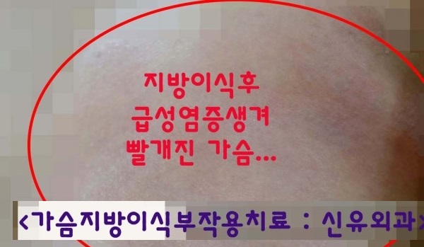 가슴자가지방이식성형수술부작용으로 유선염이 생겨서 빨개지고 열이 나서 오신 분
