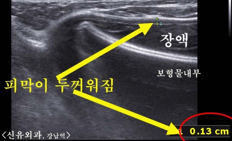 갑작스레 보형물이 들어간 가슴이 커져버려서 터질 듯이 오신 분(과다장액, 피막 두꺼워짐)