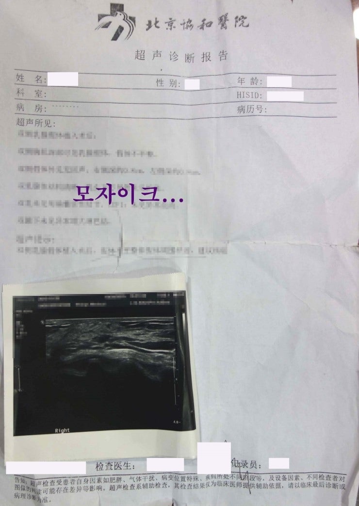 중국에서 소개 받아 오신, 가슴성형부작용이 구형구축, 이중피막, 과다장액, 과다박리, 윗볼록, 처진가슴 등 다양하게 나타났던 분