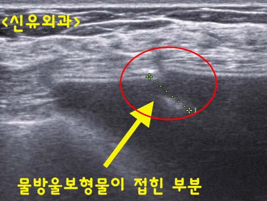 물방울가슴보형물의 유착이 떨어져 장액이 고이고 몇 군데 접힌 경우