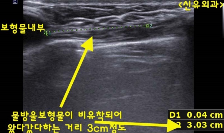 처진가슴교정술을 위해 물방울보형물을 넣었는데 비유착되어 이리저리 심하게 움직였던 분