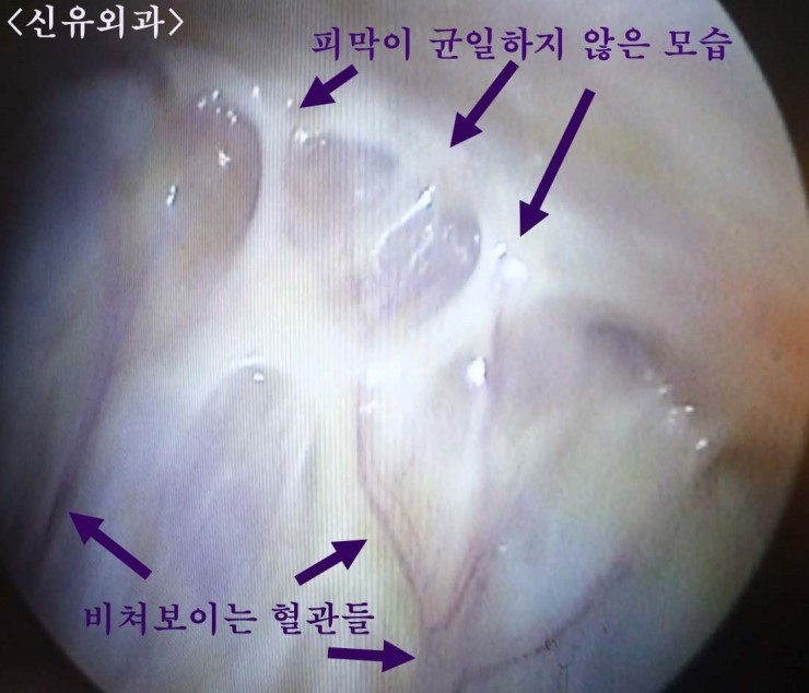 가슴보형물교체를 부분마취로 피 안 나게 제거/교체...... 이거 실화냐?