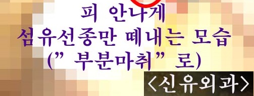 가슴 섬유선종 부분마취로 간단하게 제거하는 모습; 보형물파손제거교체와 동시에