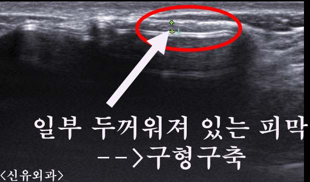 구형구축때문에 가슴보형물접히고 비대칭 : 보형물제거 겨절로 하며 맘모톰수술도 동시에. 후관리로 장액, 혈종 제거. 