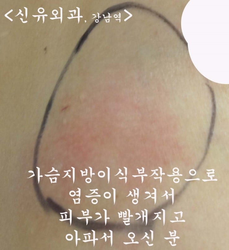 가슴지방이식부작용석회화 급성염증으로 빨개지고 아파서 오셔서 치료했는데 더 나빠지셨던 분