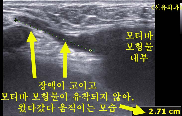 가슴보형물이 비유착되어 이러저리 움직이며 피막을 자극하던 경우