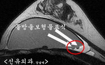 물방울보형물파손의심되어 MRI까지 찍으셨는데 염증이라 했고, 다행히 장액이 맑았던 분