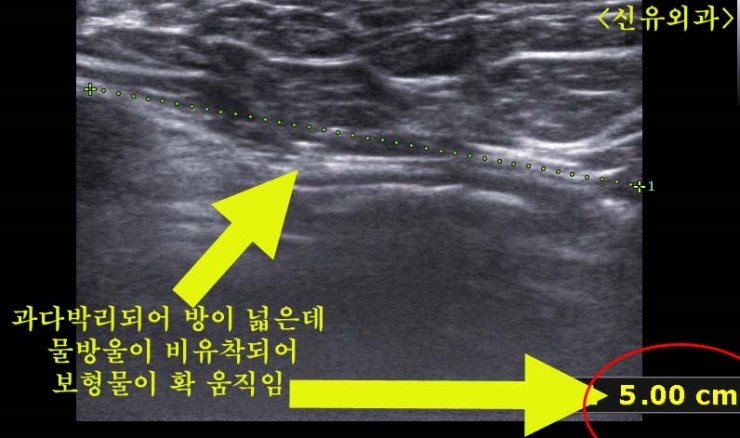 물방울보형물 비유착으로 과다박리된 방 내에서 심하게 움직였던 분, 결국 제거수술하심. 