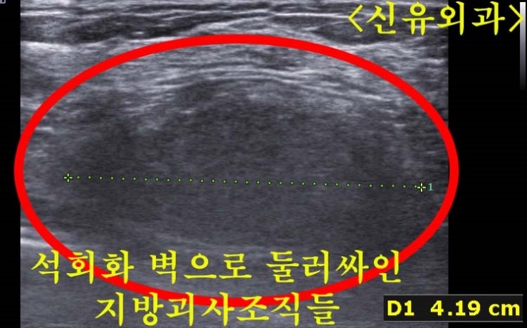 가슴지방이식부작용으로 석회화된 피막에 둘러싸인 지방괴사조직들제거