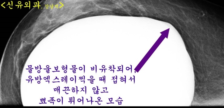 물방울보형물이 피막에 유착이 떨어져서 과다박리된 방 속에서 옆구리로 쏟아질 것 같았던 느낌. 
