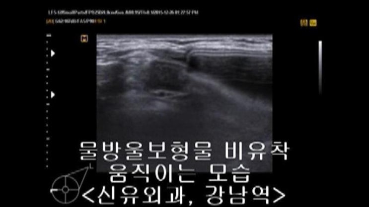 밑선이 달라서도 아니고, 유착이 떨어져서도 아니고, 가슴성형후 보형물맘모톰이 완전하게 되지 않아서 오셨던 분