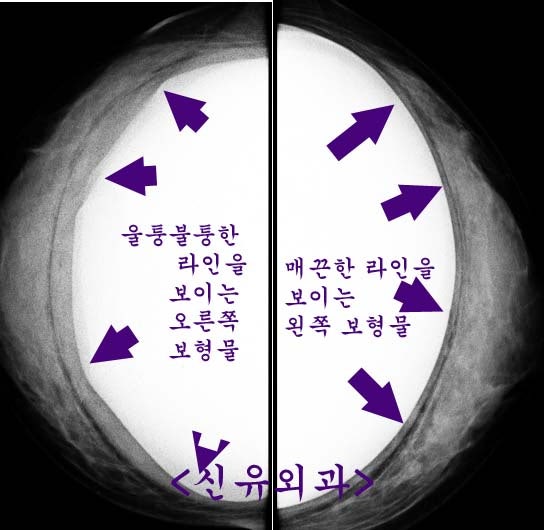 보형물 주변 액체가, 장액이 아닌 고름(농양)이었던 경우