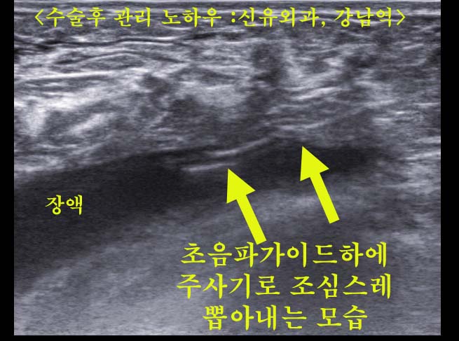 가슴보형물제거후 불편함으로 오신 분: 후관리도 수술의 중요한 한 부분입니다.