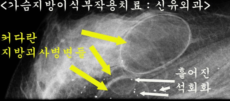 호박죽이 아닙니다. 가슴지방이식부작용멍울석회화를 제거한 지방괴사색깔입니다.