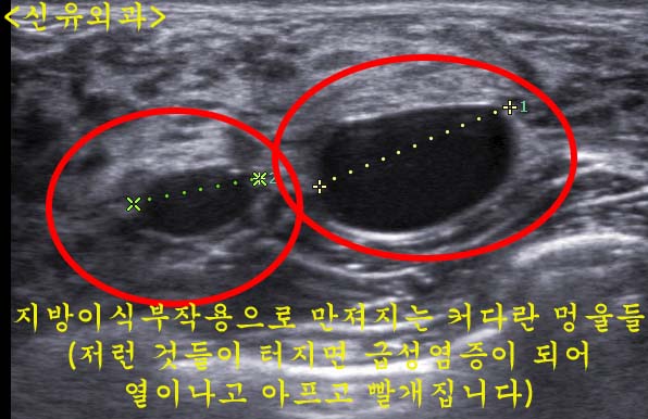 가슴지방이식부작용 석회화멍울 제거 (큰 혈관 주위라서 위험했던 분의 경우)