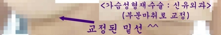 밑선비대칭을 부분마취 유륜절개하여 교정한 가슴성형재수술