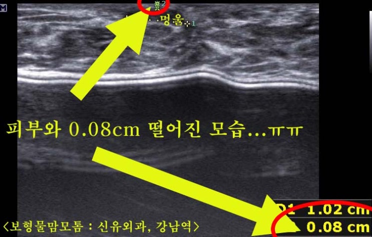 유두유륜경계부로 들어간 가슴성형후보형물맘모톰수술<피부손상위험 높은 특수한 경우>