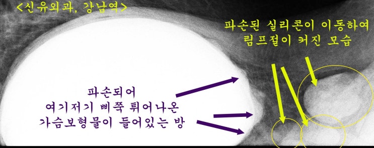 겨드랑이 만져지는 멍울의 정체는... 가슴보형물파손되어 번져나간 실리콘 내용물!