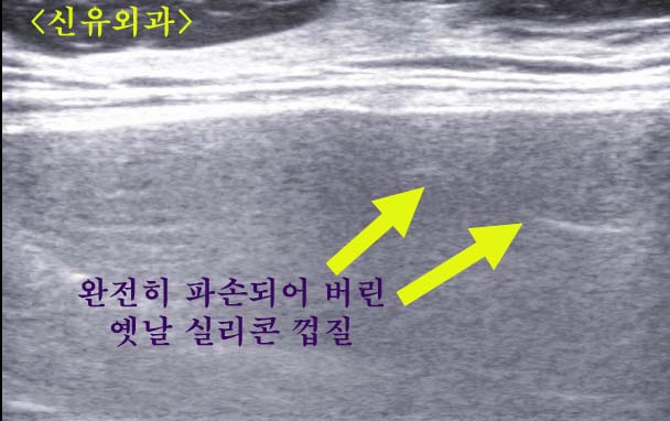 옛날 실리콘 가슴보형물 양쪽 파손을 제거하고 스무스로 교체하였는데 장액종, 혈종이 상당량 고였던 분
