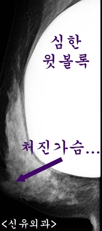 임신출산수유후 처진가슴 올리는 거상술과 작은 보형물로 교체 동시에 하신 분