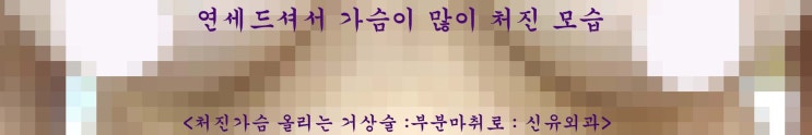 가슴보형물제거하면서 동시에 처진가슴 올리는 거상술 같이 받으신 분 : 4.5cm.