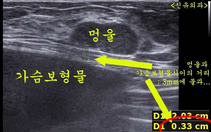 가슴보형물파손없이 3mm 떨어진 만져지는 유방멍울을 맘모톰으로 안전하게 제거한 경우