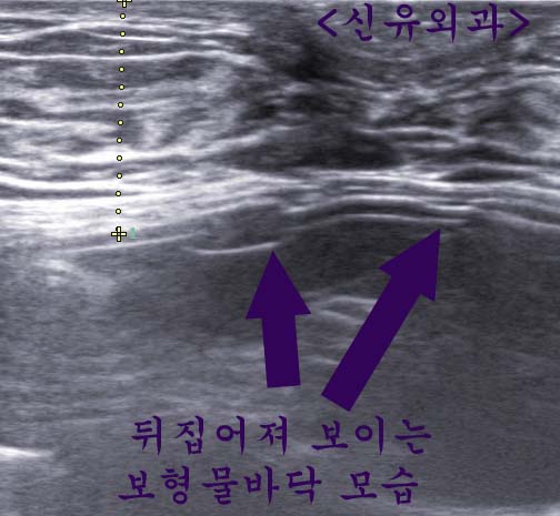 더블루멘 가슴보형물파손-->부분마취하여 교체해 드린 분