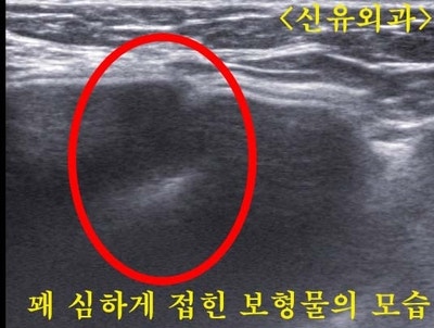 심하게 접힌 가슴보형물을 피막 두꺼워진 일부와 함께 부분마취로 제거하고, 새로 교체해 드렸던 분